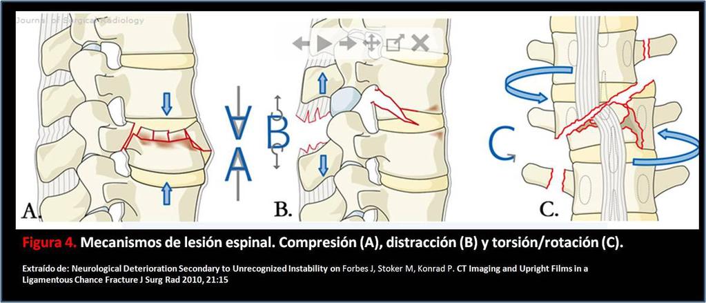 Fig. 4: Mecanismos de lesión espinal.