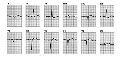 El desarrollo de la electrocardiografía de esfuerzo se basó en la observación que la depresión del segmento ST ocurre después del ejercicio en paciente con enfermedad coronaria.