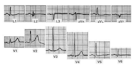 101 Cardiomiopatía hipertrófica, simula necrosis anterolateral y/o fibrosis. Figura tomada del libro Cardiología 1999, pág. 146.