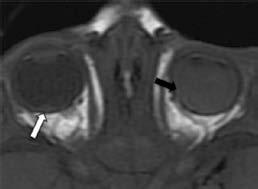 Anales de Radiología México Volumen 14, Núm. 2, abril-junio 2015 A B C D E F Figura 8. Retinoblastoma endofítico bilateral en un niño de 3 años.
