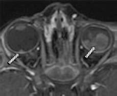E-F) Restricción en imágenes DWI (flechas blancas y curvas). A Figura 9. Niña de 1 año con retinoblastoma del ojo izquierdo.