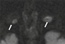 Existe un pequeño porcentaje de retinoblastomas que presenta un patrón de crecimiento infiltrativo; aparece como engrosamiento retiniano difuso sin masa