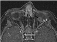 Las lesiones bilaterales tienen que ser consideradas retinoblastomas hasta no demostrar lo contrario.
