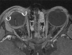 Afectación bilateral y asimétrica, las calcificaciones son raras, antecedente de bajo peso al nacer, se asocia con leucomalacia periventricular.