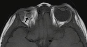 Anales de Radiología México Volumen 14, Núm. 2, abril-junio 2015 Figura 2. Microftalmia derecha (flecha negra) con aspecto hipoplásico de la vía visual intracerebral.