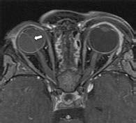 Entre el quinto y sexto meses de la gestación ocurre la apoptosis de la vasculatura hialoidea, seguida del crecimiento de las arcadas retinianas hacia la periferia.