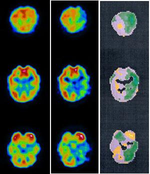 Resultados A B C Figura 33: A: SPECT cerebral interictal normal; B: SPECT realizado tras la inyección de 125 mg de amobarbital en la ACI izquierda; C: Imagen diferencia con escala paramétrica.