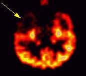 Introducción Izq. Figura 4: Tomografía por Emisión de Positrones (PET) con 18 F-FDG de un paciente con CPC del lóbulo temporal derecho.