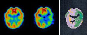 Material y métodos provocado cambios de la perfusión cerebral. El resultado se expresa como PCP en las diferentes regiones cerebrales del hemisferio anestesiado o del hemisferio contralateral.