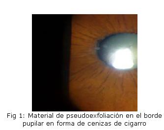 and without pseudoexfoliation. Ophthalmology. 2005;112(3):386-90. Citado en PubMed; PMID:15745763. 10. Konstas AG, Hollo G, Astakhov YS, Teus MA, Akopov EL, Jenkins JN, et al.