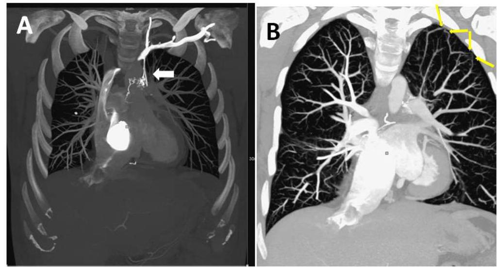 Fig. 6: Las imágenes de TC muestran múltiples fístulas arterio-venosas en el LSI (flechas amarillas) y shunts veno-venosos