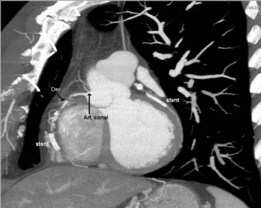 Reconstrucción volumétrica en 3D, vista PA. Dominancia derecha. Las arterias descendente posterior (resaltada en verde) y ventriculares posterolaterales se originan de la coronaria derecha. Fig. 7.