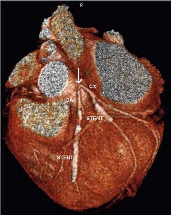 artículos de investigación Fig. 10 Anomalía de origen y curso. Origen de una coronaria en el seno opuesto con curso anómalo interarterial, hemodinámicamente significativa.