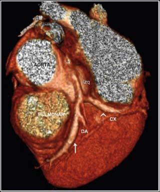 artículos de investigación A B Fig. 14. Anomalía intrínseca. Ectasia coronaria difusa. Hombre de 47 años, se realiza angiotac para estratificación de riesgo coronario.