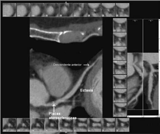 Ectasia difusa (flechas) de las coronarias alcanzando un diámetro AP de 7mm; además se evidencian placas lipídicas ateroscleróticas en la porción proximal de la descendente anterior, que causan