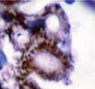 enfermedad antimembrana basal glomerular (MBG), o GP asociadas a ANCA.