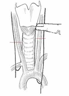 Wilfredo Perfetti y col. 297 De igual manera la localización de la arteria tiroidea inferior y su referencia con el NRL, ya sea por encima de la misma o por su parte posterior-inferior.