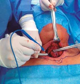 Juárez-Ferrer JC y col. Monitoreo del nervio laríngeo recurrente en cirugía tiroidea directa con la sonda de estimulación (Figura 2).