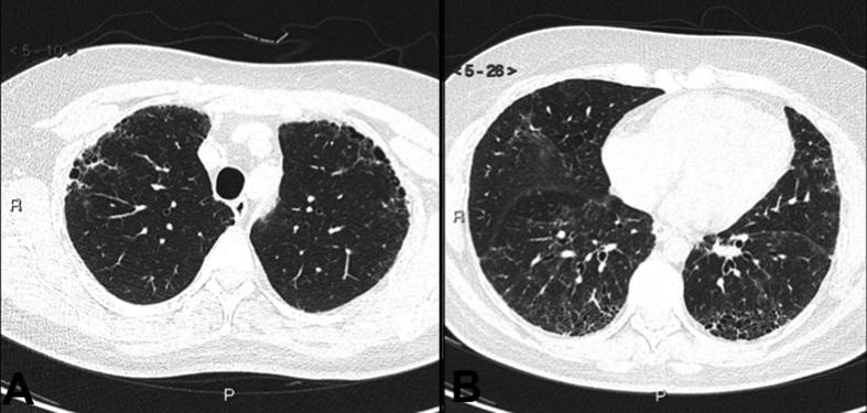 Enfermedades pulmonares difusas relacionadas al tabaco Figura 7 A y B. TC Tórax sin contraste.