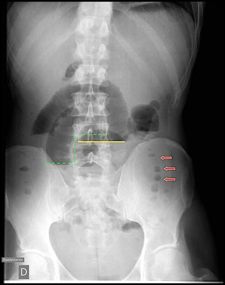 Fig 3.- Radiografía de Abdomen de pie.
