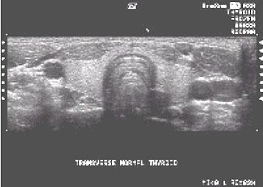 Un - El Un centellograma tiroideo con con muestra Octreotide tecnecio una (Tc-99) evalúa imagen los puede receptores la realizarse tiroides de luego más
