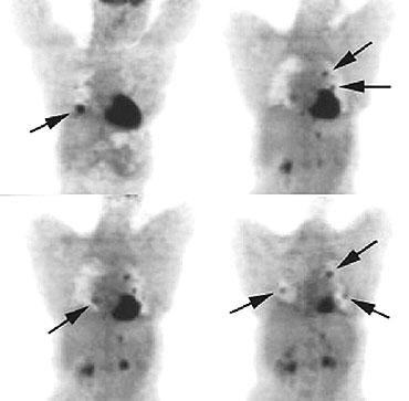 Imágenes Imagen Una - La El por RCT tomografía para PET con FDG-PET evaluar por I-131