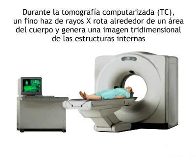 3.4.1. APLICACIONES MÉDICAS RADIODIAGNÓSTICO Rayos X convencionales. TAC: Tomografía Axial computerizada. Radioisótopos no encapsulados. Trazadores. Medicina Nuclear.