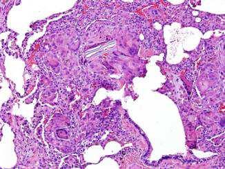 DIAGNÓSTICO DIFERENCIAL Granulomas y células
