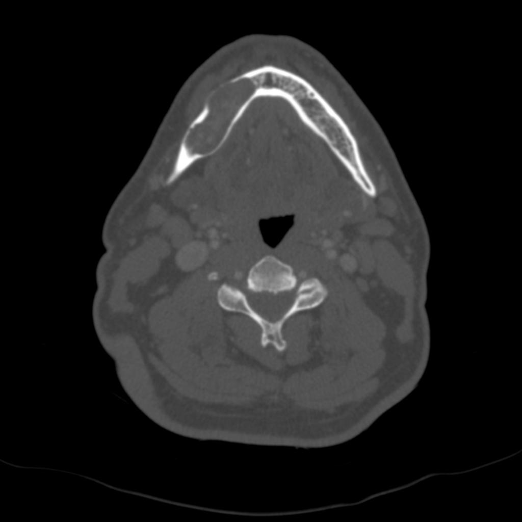 Fig. 20: Ameloblastoma gigante en cuerpo mandibular derecho, lleno de contenido