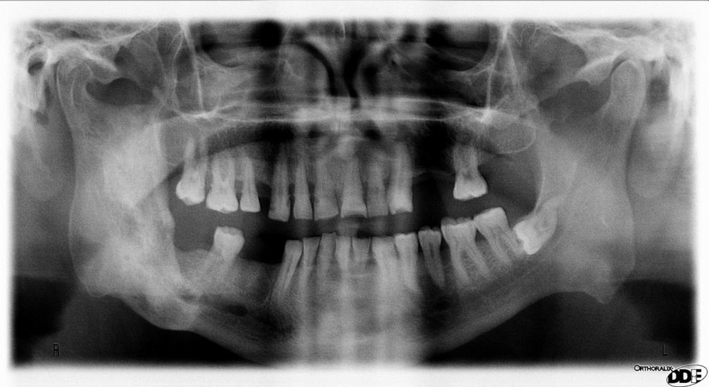 Fig. 23: Displasia Fibrosa Monostótica de la rama mandibular dcha que