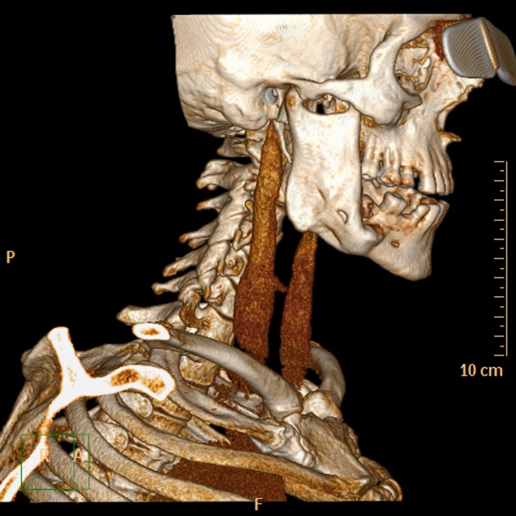 Fig. 25: Displasia Fibrosa monostótica de la rama mandibular