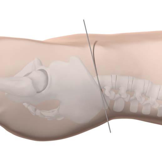 ABORDAJE Y EXPOSICIÓN Colocación del paciente Para abordar por vía anterior la columna lumbar inferior, coloque al paciente en ligera posición de Trendelenburg.