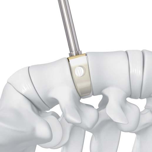 4 Inserción del implante de prueba Instrumental opcional SFW69R Prodisc-L Mazo combinado Inserte el implante de prueba en el espacio intervertebral.