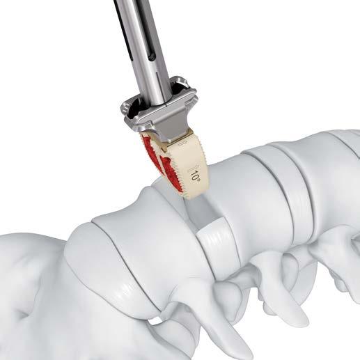 Introducción del implante Opción A: uso de guía Inserción del implante Instrumento opcional SFW69R Prodisc-L Mazo combinado Asegúrese de que la conexión entre la guía y el implante esté fija en su