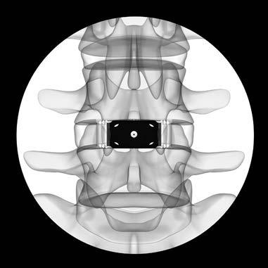 6 Comprobación de la posición En su posición óptima, el implante SYNFIX Evolution debe quedar centrado en la periferia del cuerpo vertebral y lograr un ajuste y un llenado del espacio intervertebral