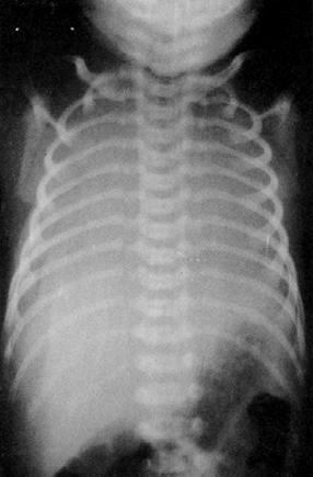 69 Figura 1a. Radiografía de tórax inicial a las dos horas del nacimiento sin intubación endotraqueal. Figura 1b.