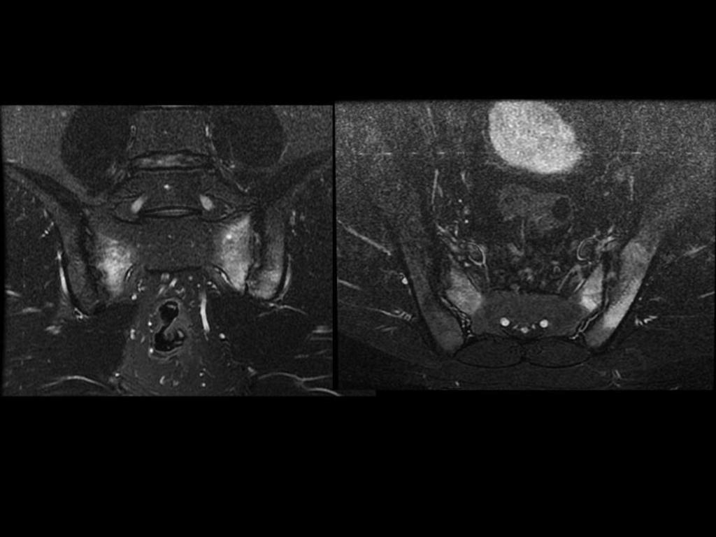 Fig. 3: Coronal T2 FS y axial STIR: Hiperseñal afectando a la vertiente sacra e ilíaca