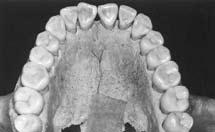 La vista oclusal inferior muestra dentición completa, rotación de incisivos (Fig. 32). Figura 27.