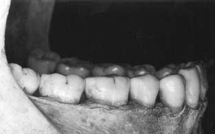 Angle consideraba el mestizaje como una posible causa de maloclusión, debido a la diferencia en el tamaño óseo y dental entre las personas de diferentes grupos étnicos 13.