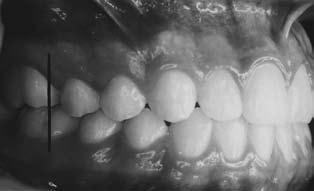 172 Rev Esp Ortod. 2010:40 Figura 2. Clase I de Angle. superiores e inferiores, y secundariamente por las posiciones individuales de los dientes con respecto a la línea de oclusión. Clase I. Está caracterizada por las relaciones mesiodistales normales de los maxilares y arcos dentales, indicada por la oclusión normal de los primeros molares.
