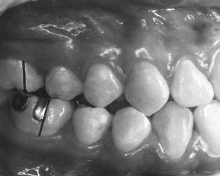 Clase III. Caracterizada por la oclusión mesial de ambas hemiarcadas del arco dental inferior hasta la extensión de ligeramente más de una mitad del ancho de una cúspide de cada lado.