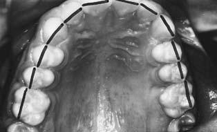 dientes que están rotados por falta de espacio; también se miden los espacios entre los dientes en milímetros 10 (Fig. 9). Figura 9.