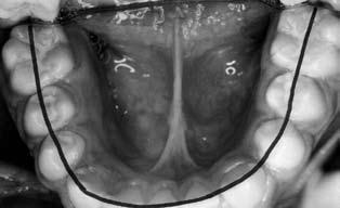 Análisis mesiodistal de cada diente 11 Se mide con un compás de dos puntos la distancia mesiodistal de cada diente en milímetros,