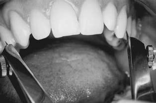 F.J. Ugalde Morales, J.A. Pompa y Padilla: Clasificación de maloclusión en la muestra Tzompantli de Tlatelolco 175 Figura 12. Ancho del arco dental. Figura 14. Ancho arco basal.