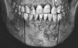 Resultados Clasificación de maloclusión y promedios: de 185 cráneos, 111 fueron rechazados por no cumplir Figura 13. Longitud del arco dental. Tabla 1.