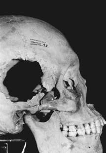 Sobremordida. Figura 24. Vista frontal de cráneo. Figura 25. Vista lateral de cráneo. Figura 26.