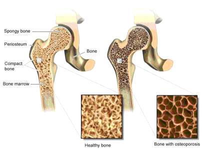 Figura 2: Estructura del hueso sano y hueso con osteoporosis La matriz ósea, está compuesta por dos componentes principales, las sustancias orgánicas y las sales inorgánicas; la porción orgánica