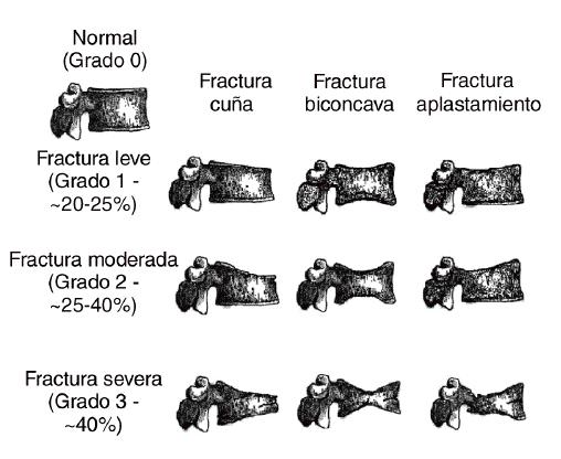 La clasificación de Genant establece tres tipos de fracturas sobre la base de la porción afectada que son tipos de fractura anterior, central y posterior² (Figura 9).