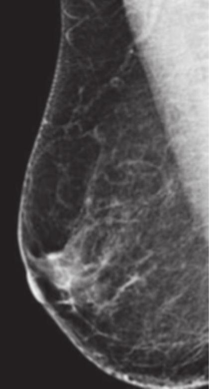 mayor del 50% puede dar cuenta de aproximadamente un tercio de los cánceres mamarios (2).