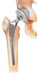 LA PRÓTESIS DE CADERA La prótesis de cadera es una articulación artificial para recambiar los extremos enfermos de los huesos y así quitar el dolor, facilitar el movimiento y poder caminar.